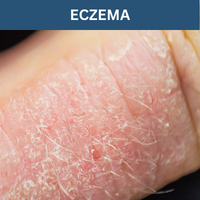 Eczema - Self Care